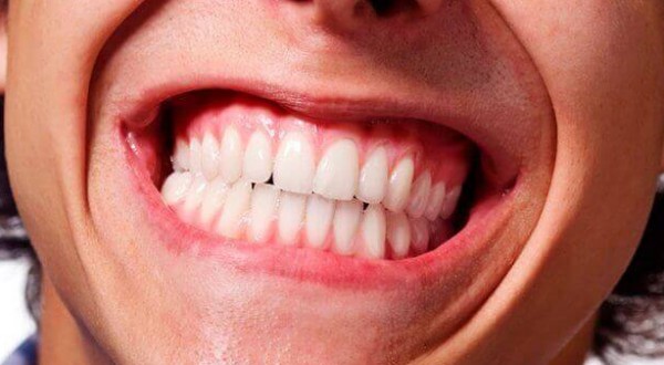 Bruxismo: cause, sintomi e trattamento
