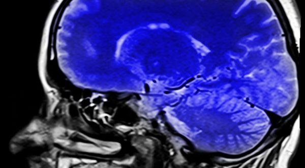 Sindrome locked-in: vivere intrappolati nel proprio corpo