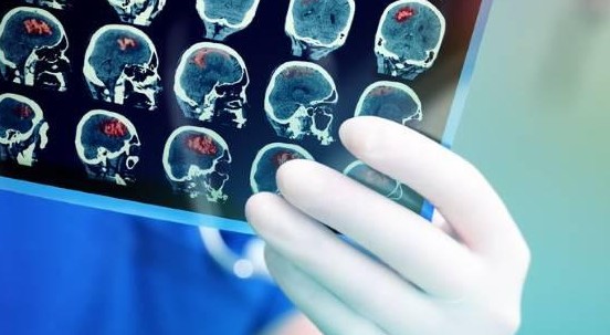 Tumori: trovato il meccanismo per bloccare le metastasi al cervello