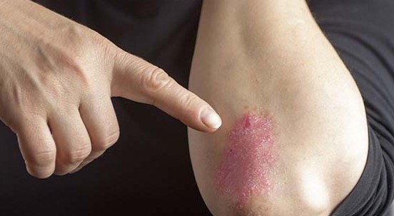 Psoriasi: la dieta mediterranea riduce l’infiammazione. Il nuovo studio