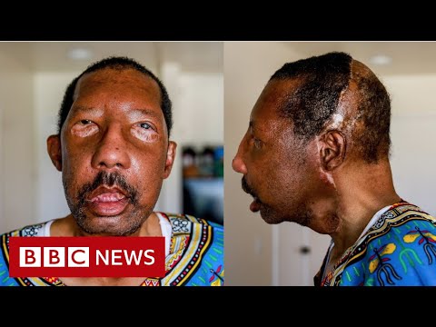 Robert Chelsea: ‘My new life with a stranger’s face’ – BBC News