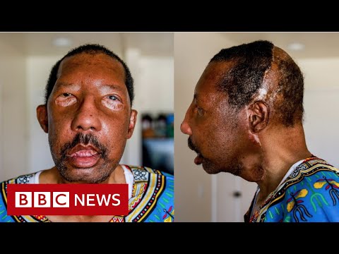 Robert Chelsea: ‘My new life with a stranger’s face’ – BBC News