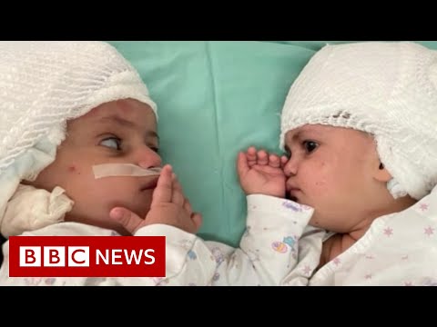 Twins conjoined at head see each other for the first time after surgery – BBC News