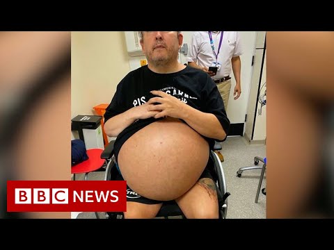 ‘Heaviest’ kidneys removed in high-risk operation – BBC News