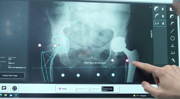 Humanitas, per le protesi d’anca un navigatore computerizzato