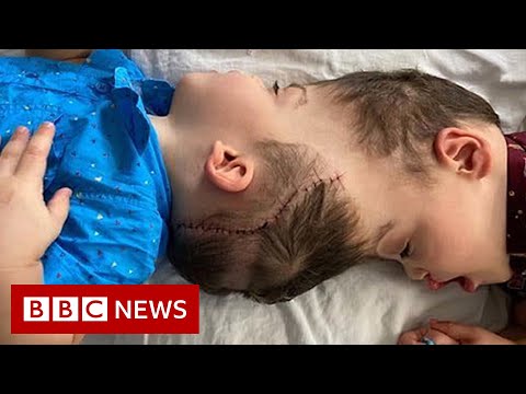 Conjoined twins separated with the help of virtual reality – BBC News