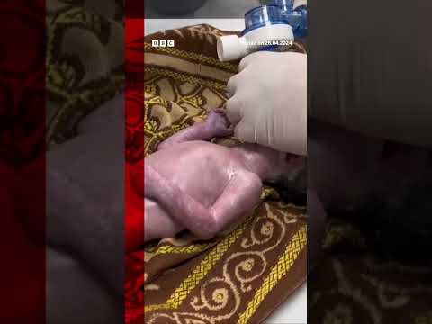 Baby saved from dead mother’s womb in Gaza dies. #Shorts #BBCNews