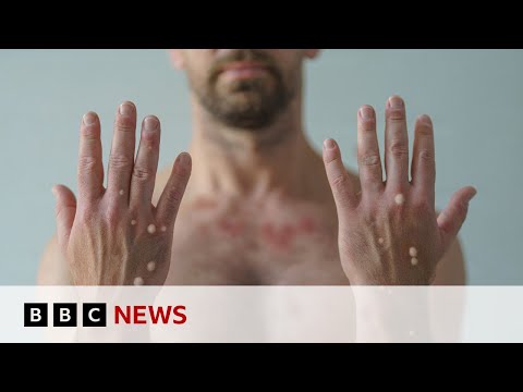 First case of more spreadable mpox detected in UK | BBC News