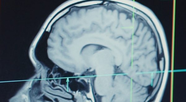 Nuove terapie per il Parkinson, a Firenze un centro per il supporto