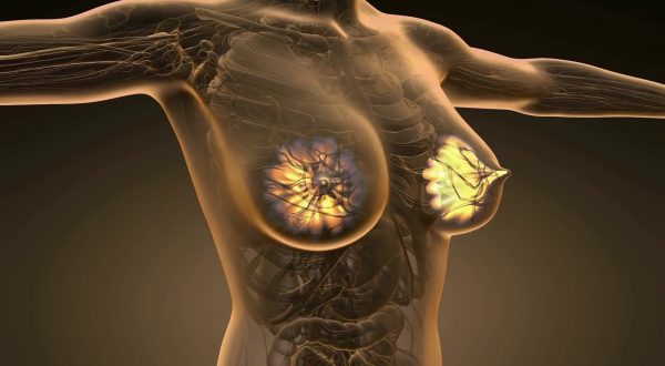 Il ruolo dei linfociti T nel carcinoma mammario