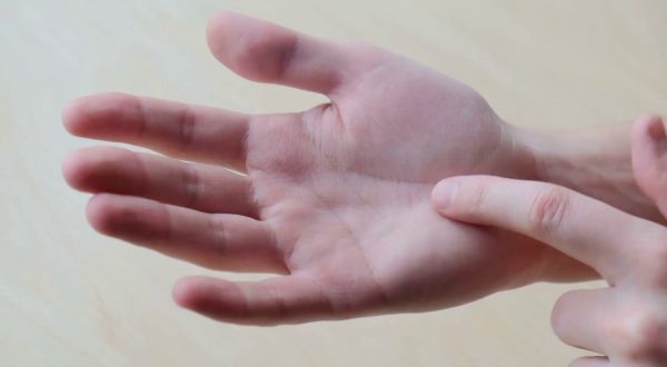 Sindrome del tunnel carpale, ecco chi è più a rischio