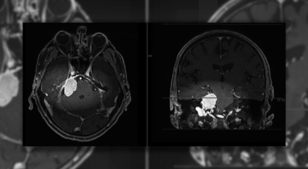 Meningiomi, i sintomi da tenere d’occhio