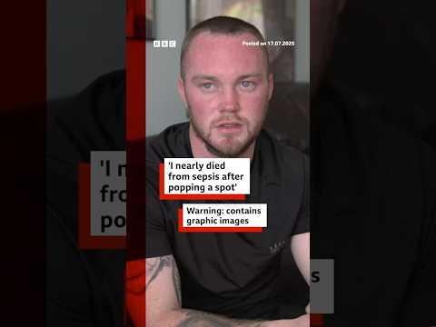 Popping a pimple led to a man getting sepsis. #BBCNews