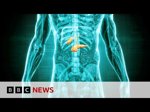 Detecting ‘hidden’ pancreatic cancer cases | BBC News