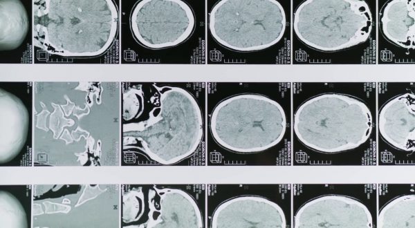 Glioblastoma, le molecole naturali migliorano la chemioterapia