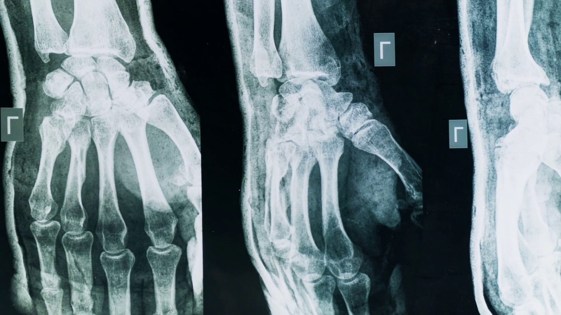 Artrite e artrosi, come riconoscerle e curarle