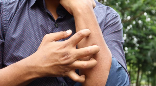 Studio Novartis, l’orticaria cronica spontanea costa 4.200 euro l’anno a paziente