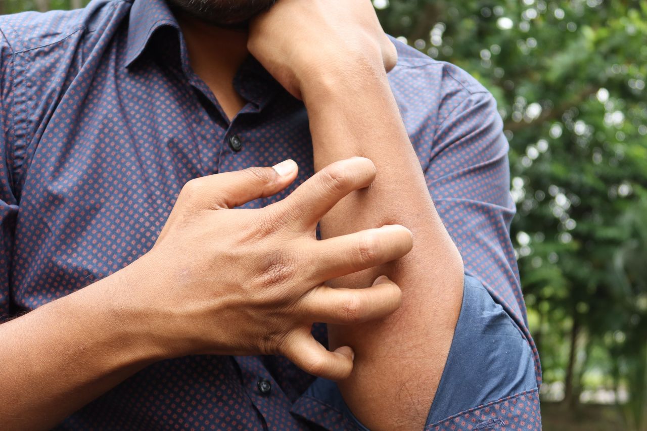 Studio Novartis, l&rsquo;orticaria cronica spontanea costa 4.200 euro l&rsquo;anno a paziente