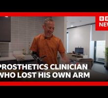 &lsquo;I worked with prosthetic limbs, then I lost my arm&rsquo; | BBC News